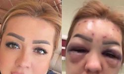 Botoks bu hale getirdi: Yüzü şişti tanınmayacak hale geldi