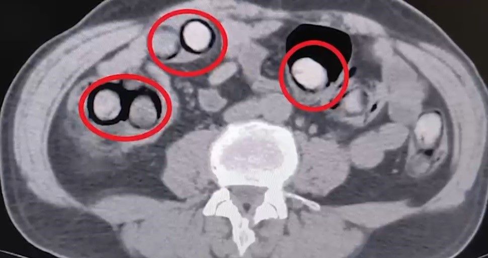 Mide ve bağırsaklarından 758 gram uyuşturucu çıktı